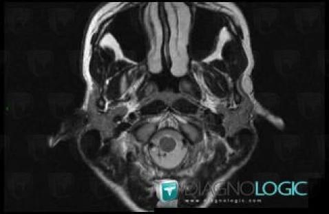 Sebaceous cyst, Soft tissues - Head and neck, MRI