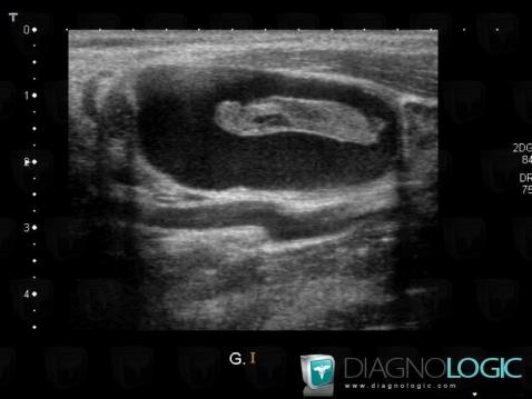 Second branchial cleft cyst, Deep facial spaces, US