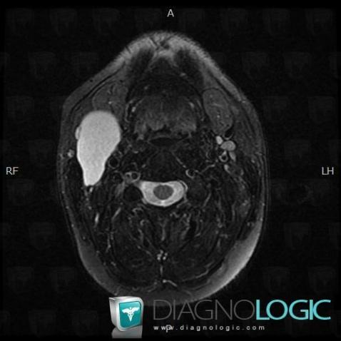 Second branchial cleft cyst, Deep neck spaces, MRI