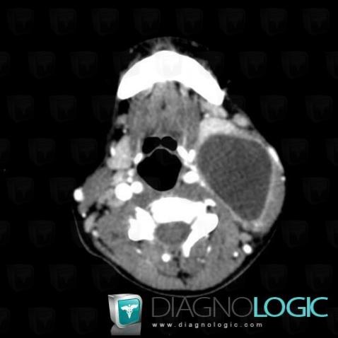 Second branchial cleft cyst, Oropharynx / Floor-mouth, Deep facial spaces, CT