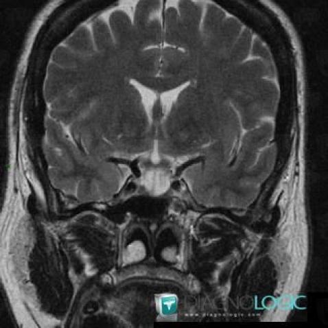 Selle turcique vide , Hypophyse et région parasellaire, IRM