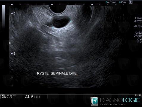 Radiology case : Seminal vesicle cyst (US) - Diagnologic