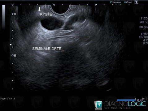 Radiology case : Seminal vesicle cyst (US) - Diagnologic