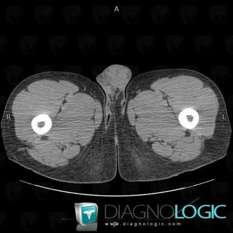 Seminoma, Scrotum, CT