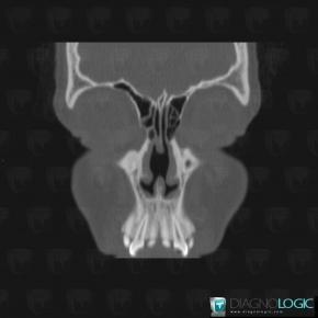 Septal perforation, Nasal cavity / Nasopharynx, CT
