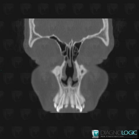 Septal perforation, Nasal cavity / Nasopharynx, CT
