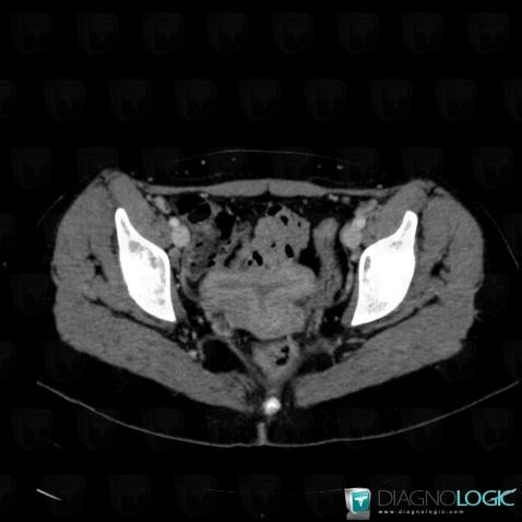 Septate uterus, Uterus, CT