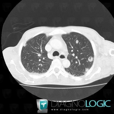 Septic pulmonary emboli, Pulmonary parenchyma, CT