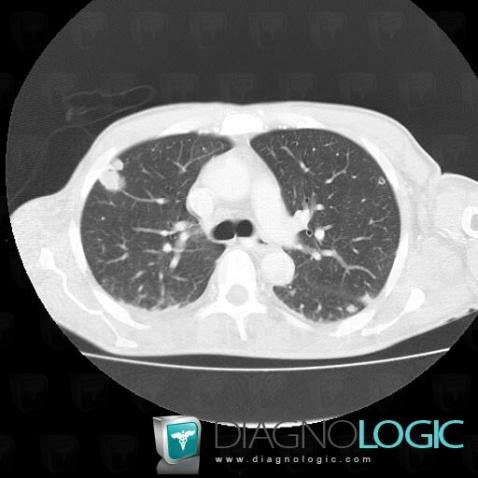 Septic pulmonary emboli, Pulmonary parenchyma, CT