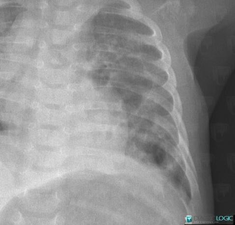 Séquéstration pulmonaire intralobaire, Parenchyme pulmonaire, Radio