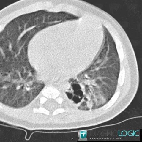 Séquéstration pulmonaire intralobaire, Parenchyme pulmonaire, Scanner