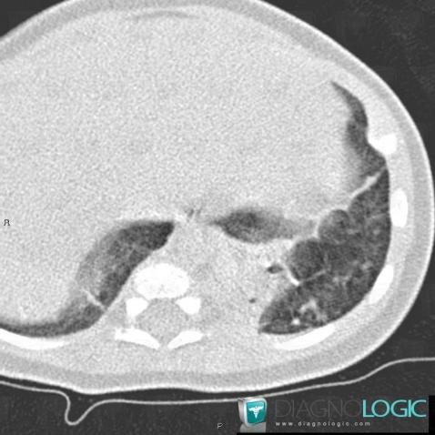 Séquéstration pulmonaire intralobaire, Parenchyme pulmonaire, Scanner