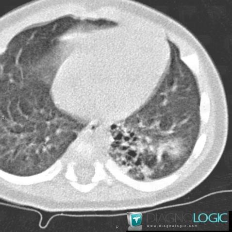 Séquéstration pulmonaire intralobaire, Parenchyme pulmonaire, Scanner