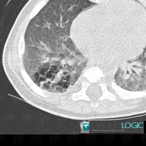 Séquéstration pulmonaire intralobaire, Parenchyme pulmonaire, Scanner