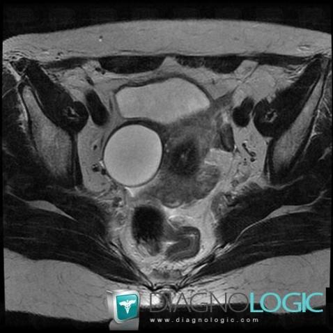 Serous cystadenoma, Adnexa / Ovary fallopian tube, Pelvis / Perineum, MRI