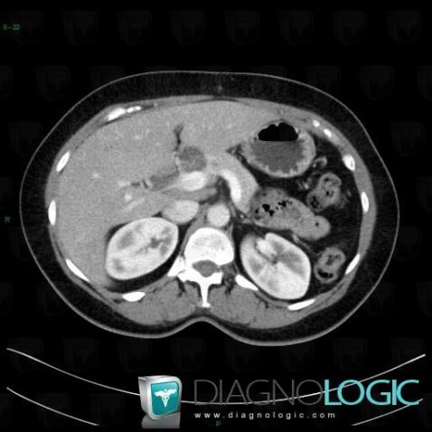 Serous cystadenoma, Pancreas, CT