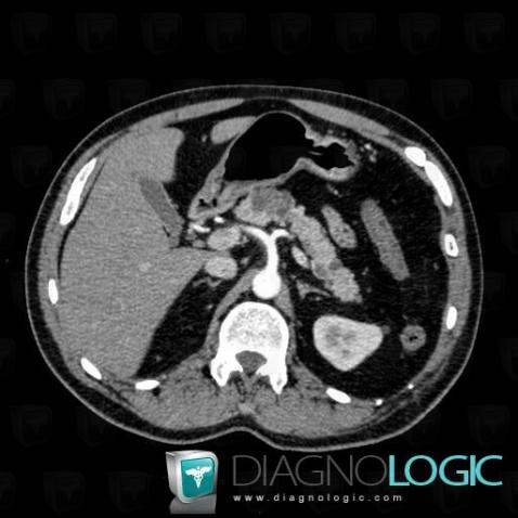 Serous cystadenoma, Pancreas, CT