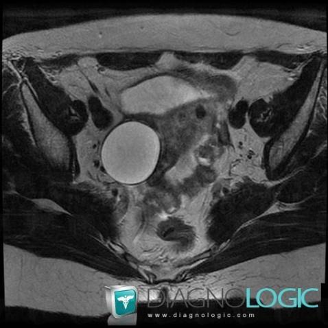 Serous cystadenoma, Pelvis / Perineum, MRI