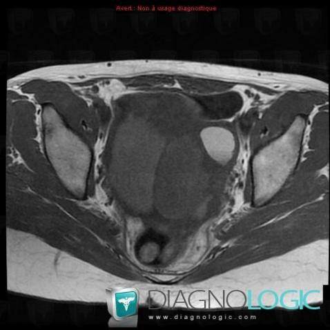 Serous cysteadenocarcinoma, Adnexa / Ovary fallopian tube, MRI