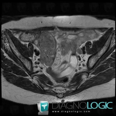 Serous cysteadenocarcinoma, Adnexa / Ovary fallopian tube, Pelvis / Perineum, MRI