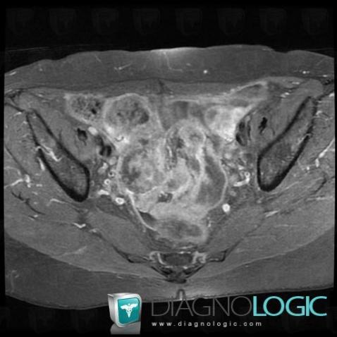 Serous cysteadenocarcinoma, Adnexa / Ovary fallopian tube, Pelvis / Perineum, MRI
