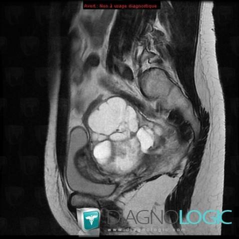 Serous cysteadenocarcinoma, Adnexa / Ovary fallopian tube, Pelvis / Perineum, MRI