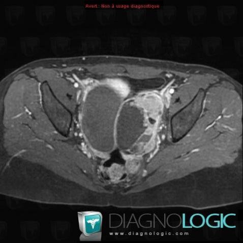 Serous cysteadenocarcinoma, Adnexa / Ovary fallopian tube, Pelvis / Perineum, MRI