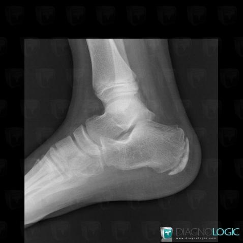 Sever disease, Calcaneus, X rays