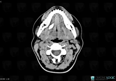 Sialolithiasis, Oropharynx / Floor-mouth, Parotid and other salivary glands, CT