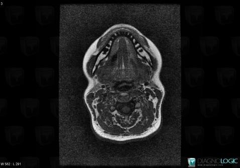 Sialolithiasis, Oropharynx / Floor-mouth, Parotid and other salivary glands, MRI