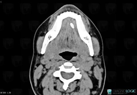 Sialolithiasis, Parotid and other salivary glands, CT