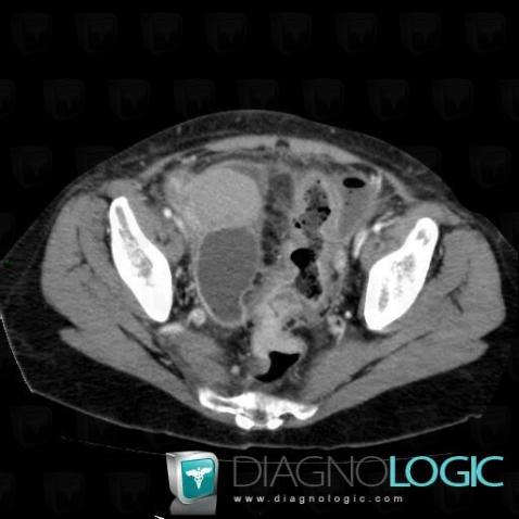 Sigmoid cancer, Colon, CT