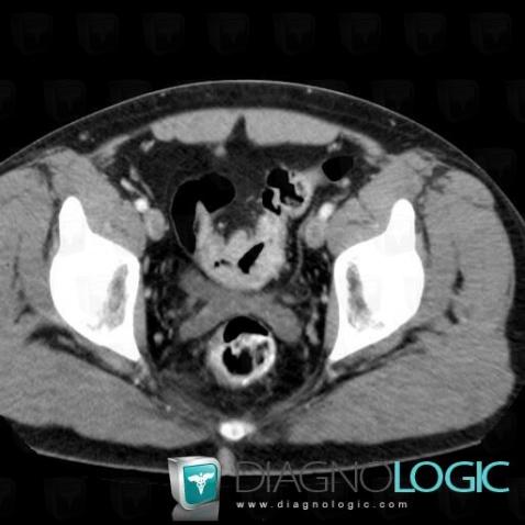 Sigmoid cancer, Colon, CT