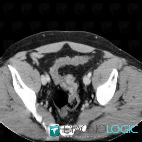 Sigmoid cancer, Colon, CT