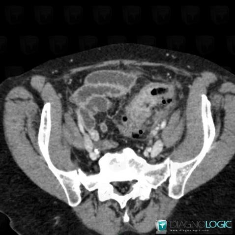 Sigmoid cancer, Colon, CT