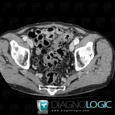 Sigmoid diverticulosis, Colon, CT