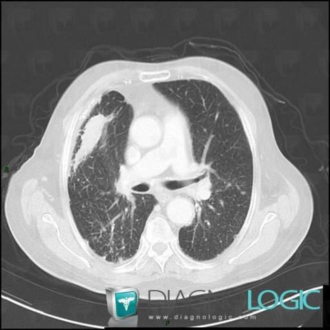 Silicose, Parenchyme pulmonaire, Scanner