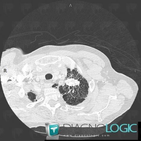 Silicose, Parenchyme pulmonaire, Scanner