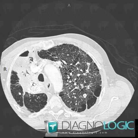 Silicose, Parenchyme pulmonaire, Scanner