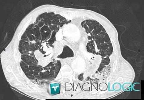 Silicose, Parenchyme pulmonaire, Scanner