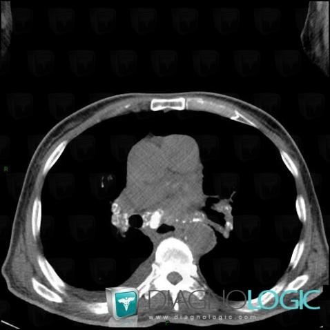 Silicosis, Mediastinum, CT