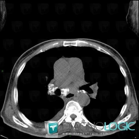 Silicosis, Mediastinum, CT