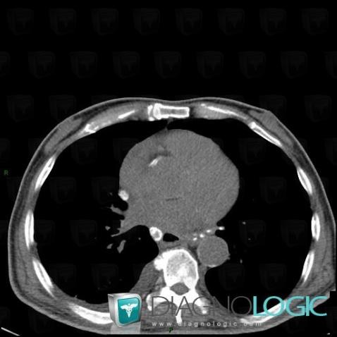 Silicosis, Mediastinum, CT