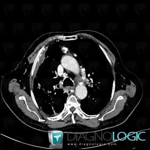 Silicosis, Mediastinum, CT