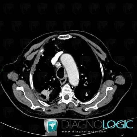 Silicosis, Mediastinum, CT