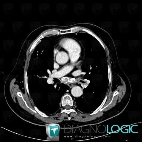 Silicosis, Mediastinum, CT