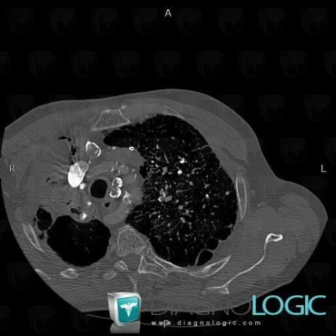 Silicosis, Mediastinum, CT