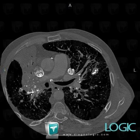 Silicosis, Mediastinum, CT