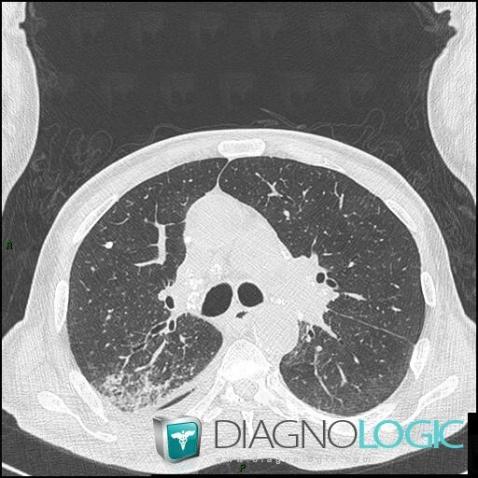 Silicosis, Pulmonary parenchyma, CT