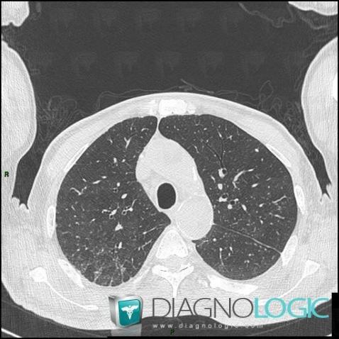 Silicosis, Pulmonary parenchyma, CT